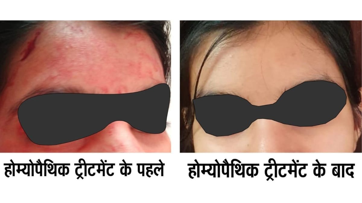 Rare disease Blood-Sweating Disorder Successfully Treated with Advanced Homeopathy – Dr AK dwivedi