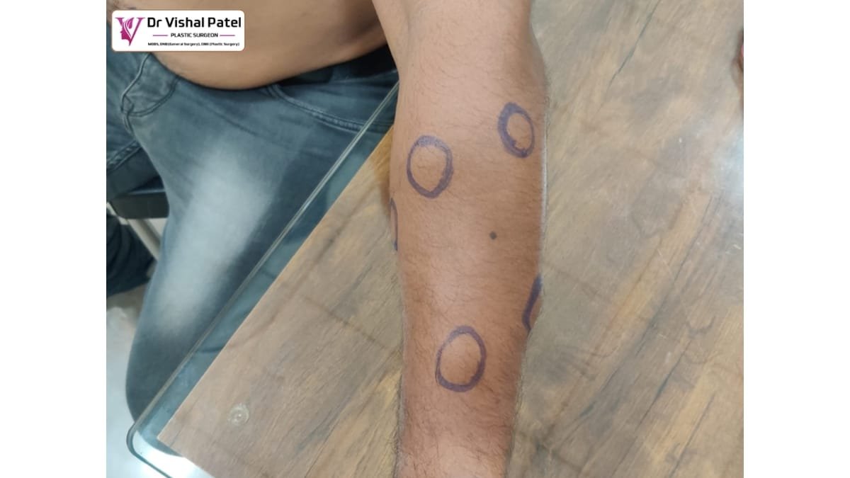 Rare Case of 30+ Multiple Lipomas in Mumbai Treated at Recon Plastic Surgery & Physiotherapy Clinic, Mumbai -PNN